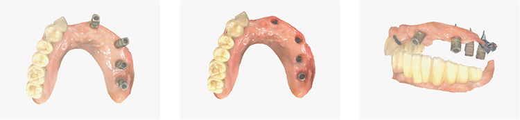 Rapid 3 Intraoral Scanner